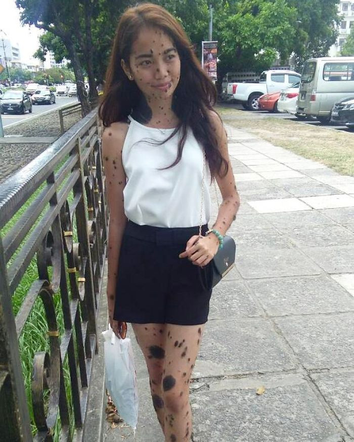 Theo thông tin đăng tải, những mụn nốt ruồi đã xuất hiện trên cơ thể của Evita từ khi cô còn là một đứa trẻ. Qua thời gian, những nốt ruồi ngày càng xuất hiện nhiều và kích thước cũng ngày một lớn. (Nguồn Bored Panda)