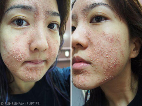 Cô gái H.O đã chia sẻ bức hình sau một thời gian dùng kem trộn. Từ người có da mặt mịn màng, cô khiến dân mạng hoảng hồn vì da ửng đỏ cả mảng lớn, mụn mọc li ti. Theo đó, da H.O rơi vào tình trạng ấy sau một thời gian sử dụng lọ kem do chồng tương lai mua tặng từ người quen.