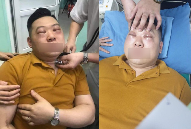 Sốc phản vệ nặng sau khi thái một củ hành Soc phan ve nang sau khi thai mot cu hanh