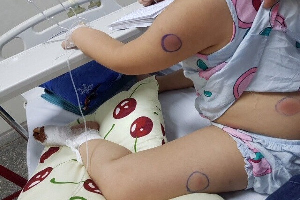 Bị gà mổ, bé 5 tuổi ở Quảng Bình nhiễm khuẩn Whitmore Bi ga mo, be 5 tuoi o Quang Binh nhiem khuan Whitmore