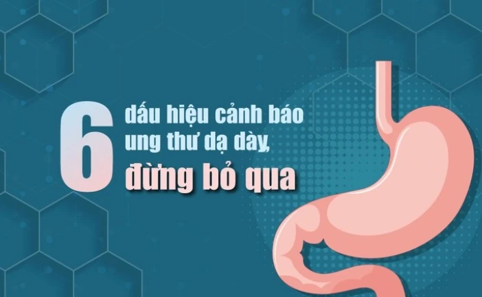 6 dấu hiệu cảnh báo ung thư dạ dày