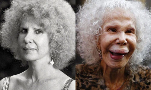 Phát khiếp với 15 "thảm họa dao kéo" khuôn mặt biến dạng