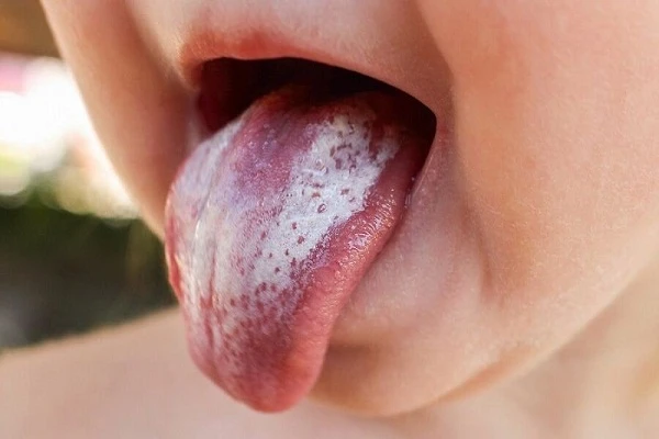 Dấu hiệu ở lưỡi cảnh báo nguy cơ ung thư phải thật lưu ý