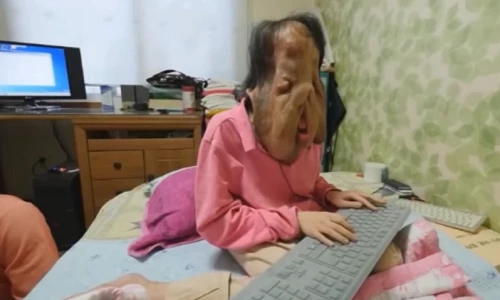 Bệnh lạ biến người phụ nữ Hàn Quốc thành quái vật