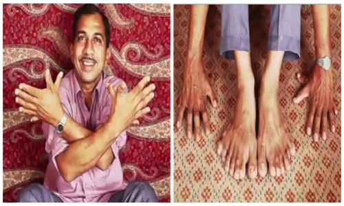 Clip người đàn ông có nhiều ngón tay chân nhất thế giới