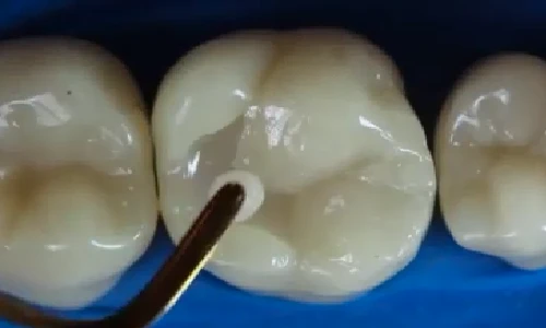 Tường tận quy trình nha sĩ biến răng sâu thành răng đẹp