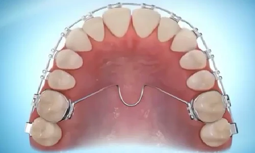 Chi tiết quy trình niềng răng có thể bạn chưa biết