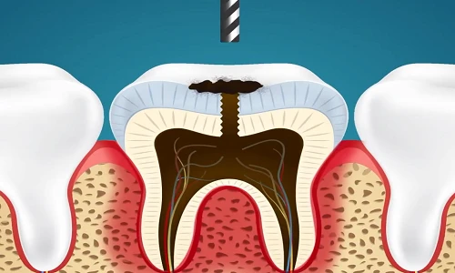 Xem cách nha sĩ nhổ răng sâu