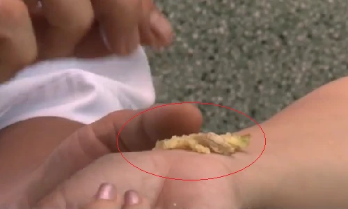 Ba cách xóa tan vết bầm tím nhanh nhất