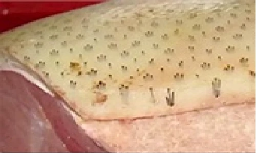 Ăn bì lợn có thể bị thủng dạ dày