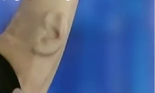 Người đàn ông có tai thứ 3 kỳ lạ trên cánh tay