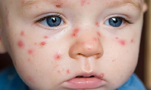 Những cách ngăn ngừa sẹo do thủy đậu ở trẻ em