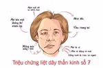 Bác sĩ khuyến cáo, không chủ quan với liệt dây thần kinh số 7