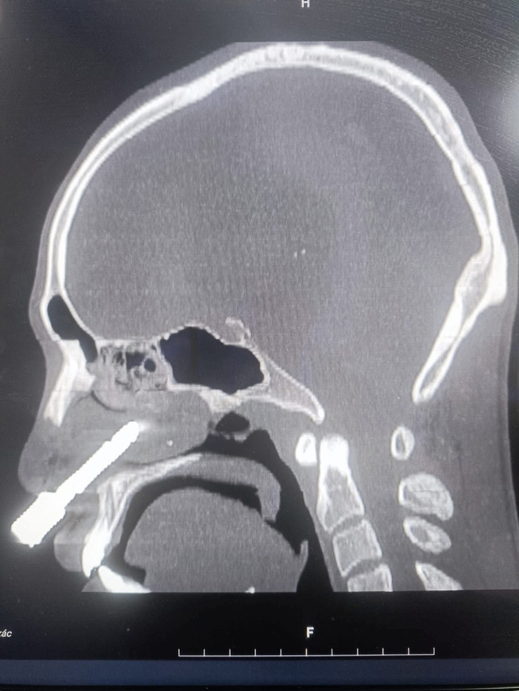Kết quả chụp cắt lớp vi tính (CT-Scan) và dựng hình ảnh 3D cho thấy dị vật là một mũi khoan kim loại dài khoảng 7–8cm, có hình cong như lưỡi câu. divatmuikhoan.jpg
