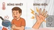 Nhiều ca bỏng nặng do sinh hoạt, người dân cần biết cách sơ cứu