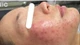 Mảng đỏ trên mặt, cẩn thận bệnh trứng cá đỏ