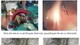 Nút mạch cứu sống bệnh nhân ho ra máu nặng ngừng tuần hoàn
