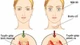 Ngừng thuốc kháng giáp có tái phát bệnh Basedow?