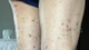 Sống chung với nốt sẩn ngứa 10 năm, không ngờ bệnh hiếm ác tính
