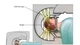 Ung thư di căn não điều trị thế nào hiệu quả?