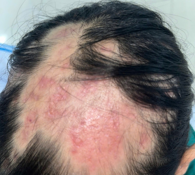 Sau 6 tuần điều trị bệnh đã khỏi hoàn toàn và tóc bắt đầu mọc trở lại - Ảnh BVCC ap-xe-dau-nam2-2584.jpg