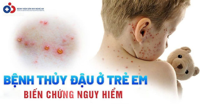 thuy-dau-ac-tih.jpg