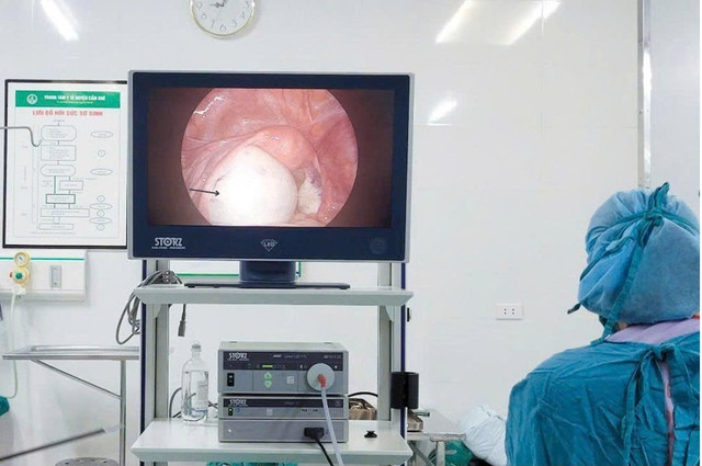 Nội soi phát hiện u buồng trứng - Ảnh BVCC u-quai-buong-trung-22.jpg