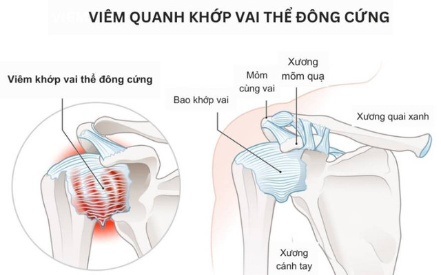 dong-cung-khop-vai-1.jpg