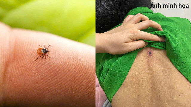 Tổn thương gan phổi khởi phát từ một vết loét nhỏ tưởng chừng vô hại - Ảnh BVCC sot-mo.jpg
