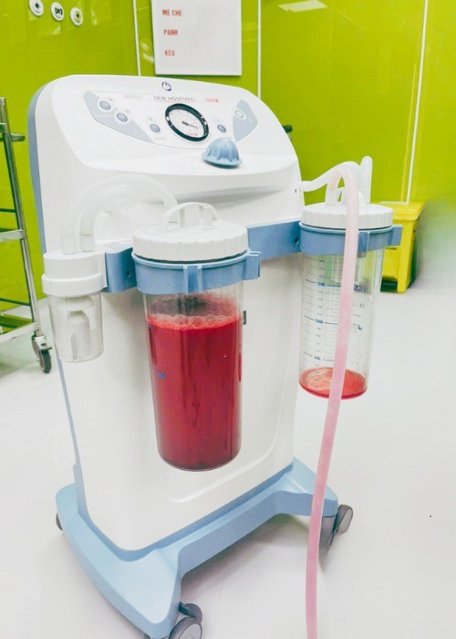 1500 ml máu đã được lấy ra khỏi ổ bụng sản phụ - Ảnh BVCC xuat-huyet.jpg