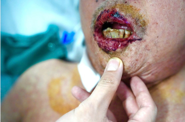Bệnh nhân loét môi - Ảnh BVCC loet-gut-1.jpg