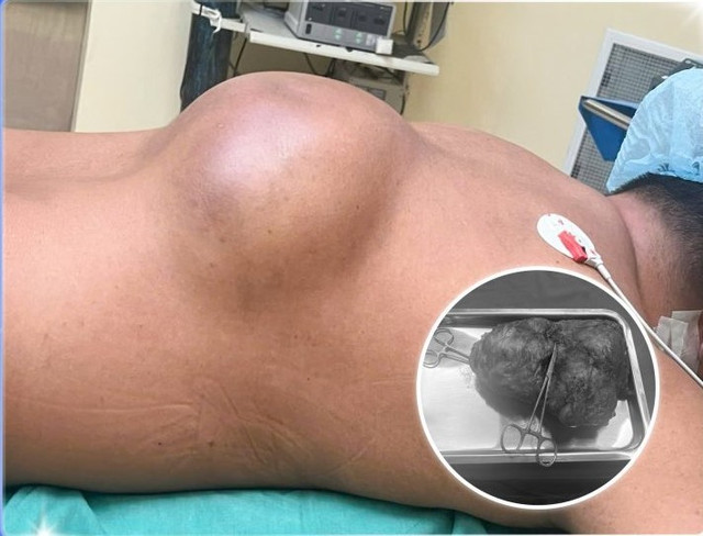 U khổng lồ trên lưng bệnh nhân hơn 10 năm - Ảnh BVCC u-khung.jpg