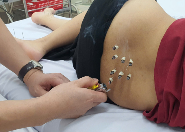 Đông Y trị bí tiểu sau sinh - Ảnh BVCC bi-tieu-sau-sinh-1.jpg