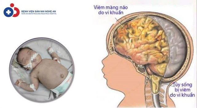 Trẻ mới 20 ngày tuổi đã bị viêm não mô cầu - Ảnh BVCC 505829312-1126538186176349-5036538241496101583-n.jpg
