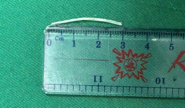 Chiếc xương cá được lấy ra - Ảnh BVCC xuong-dam-2-2557.jpg