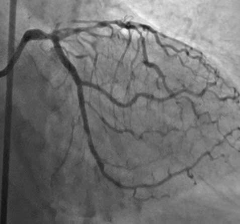 Hình ảnh sau đặt Stent động mạch mũ - Ảnh BVCC nhoi-mau-4.jpg