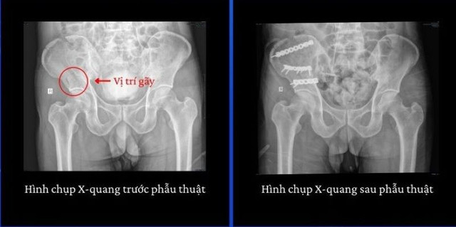 Hình ảnh CT của bệnh nhân - Ảnh BVCC nga-mai-nha.jpg
