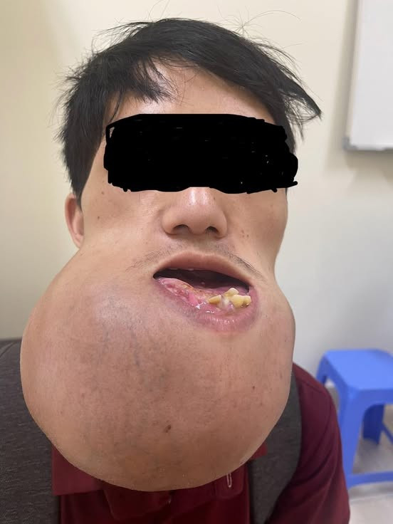 Khối u sơ sinh xương khổng lồ ở bệnh nhân - Ảnh BSCC u-xo-sinh-xuong.jpg