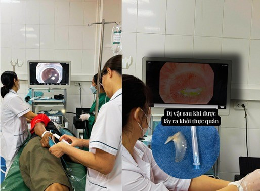 Nội soi lấy dị vật xương cá ra khỏi thực quản bệnh nhân - Ảnh BVCC hoc-xuong-ca.jpg