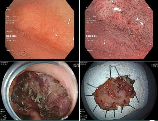 Tổn thương được cắt bỏ sau phẫu thuật - Ảnh BVCC da-day-3.jpg