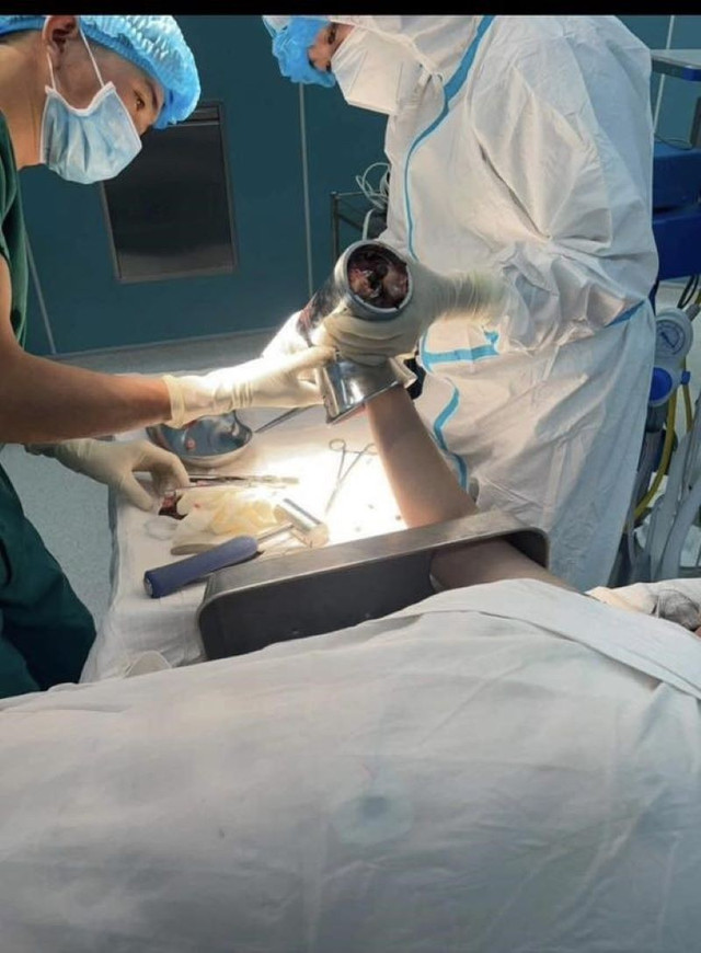Xử lý máy xay thịt ra khỏi bàn tay - Ảnh BVCC 501005275-3103929226412321-3976219953561895019-n-960.jpg