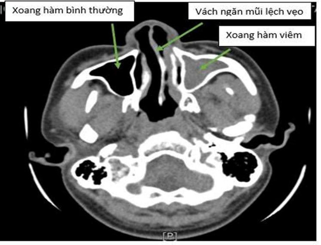 Hình ảnh vẹo vách ngăn mũi trên nội soi - Ảnh BVCC veo-vach-ngan-mui-1.jpg