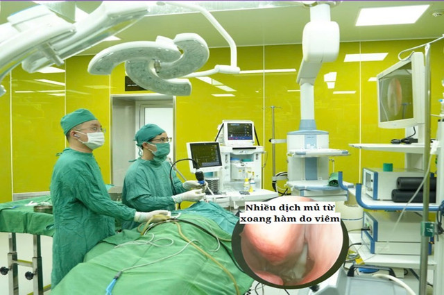 Ca phẫu thuật vẹo vách ngăn mũi cho bệnh nhân - Ảnh BVCC veo-vach-ngan-mui.jpg