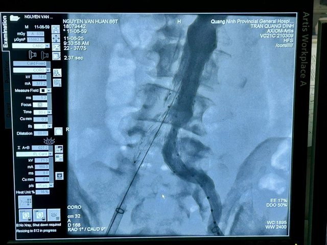 Hình ảnh chụp từ hệ thống DSA cho thấy stent graft đã được đặt đúng vị trí khối phình động mạch - Ảnh BVCC stnet-1.jpg