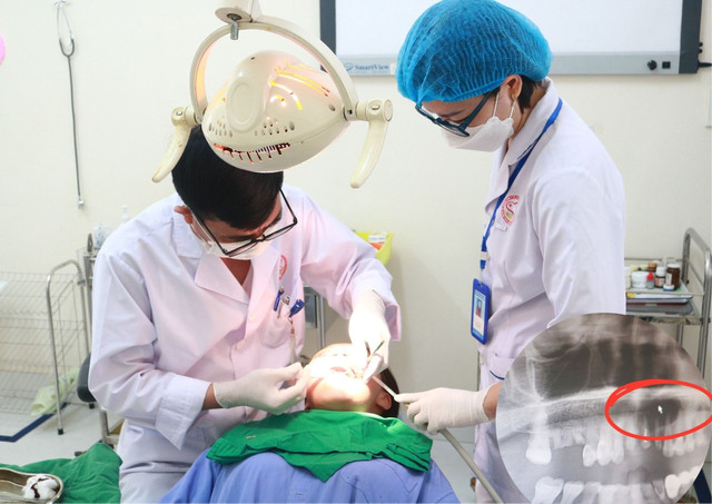 Công nghệ PRF điều trị nang xương hàm - Ảnh BVCC xuong-ham.jpg