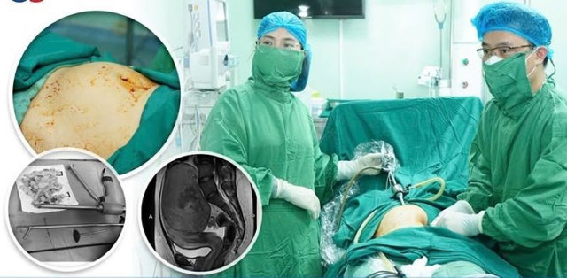Phẫu thuật nội soi lấy u kích thước lớn cho bệnh nhân - Ảnh BVCC noi-soi-cat-u-xo-tu-cung.jpg