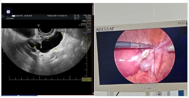 Hình ảnh siêu âm và nội soi phẫu thuật cho bệnh nhân - Ảnh BVCC mu-buong-trung.jpg