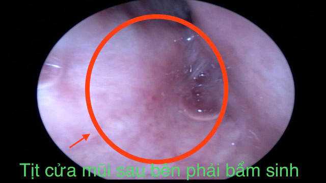 Ảnh BSCC tit-cua-mui-2.jpg