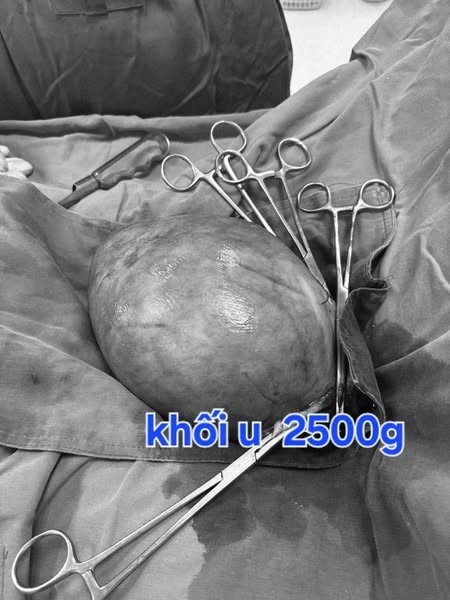 Khối u cơ trơn khổng lồ đã được lấy ra - Ảnh BVCC 2-mo.jpg