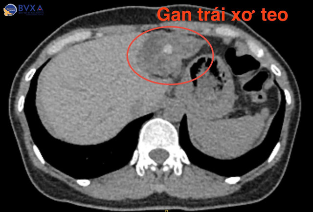 Gan trái xơ teo vì sỏi - Ảnh BVCC soi-gan.jpg